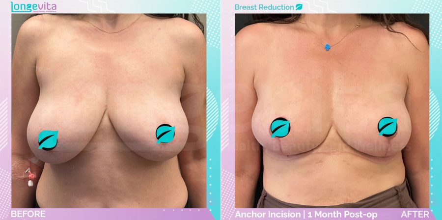Breast Reduction before and after, Breast