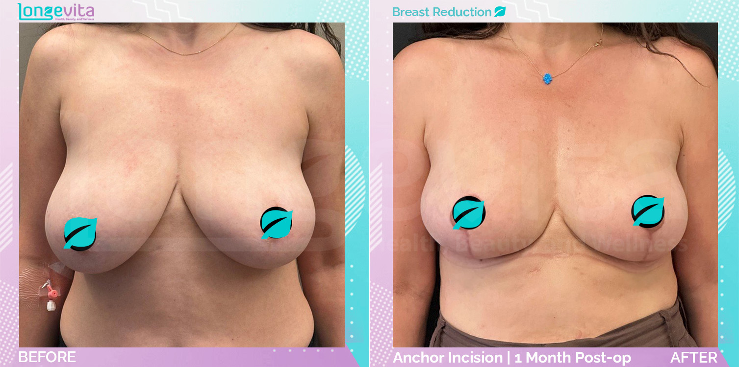 Breast Reduction before and after, Breast