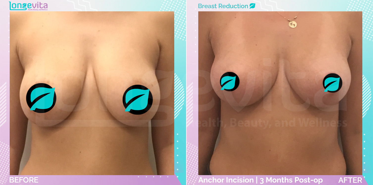 Breast Reduction before and after, Breast