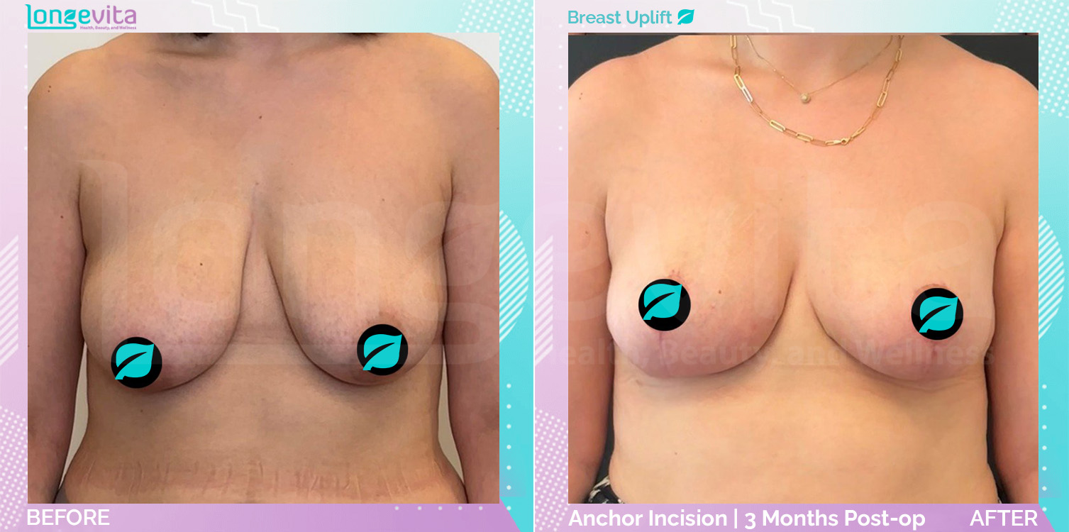 Breast Lift before and after, Breast