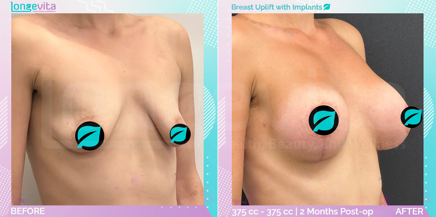 Breast Enlargement and Breast Lift before and after, Breast