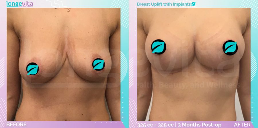 Breast Enlargement and Breast Lift before and after, Breast