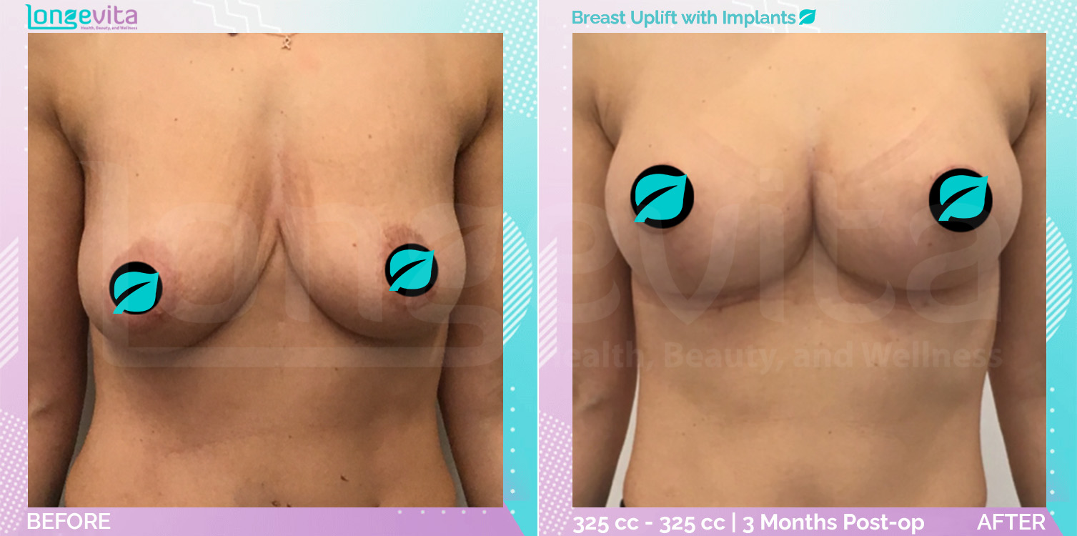 Breast Enlargement and Breast Lift before and after, Breast