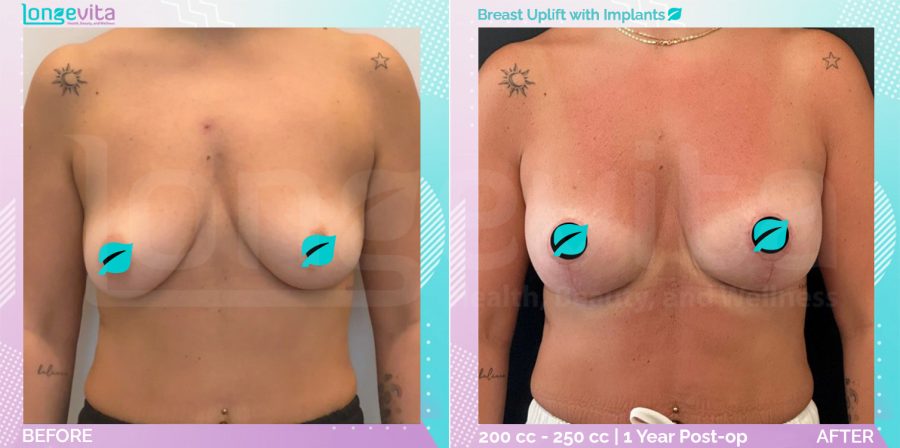 Breast Enlargement and Breast Lift before and after, Breast