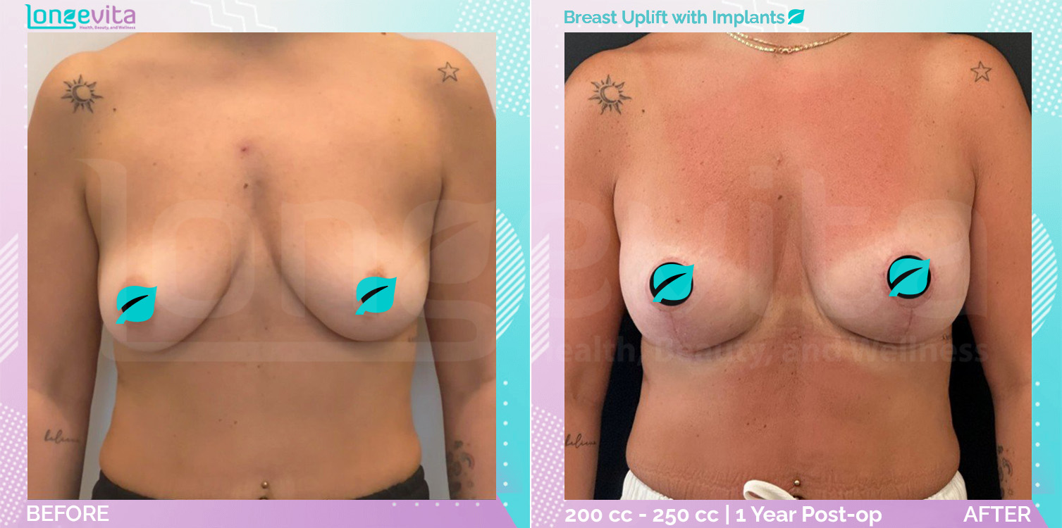 Breast Enlargement and Breast Lift before and after, Breast
