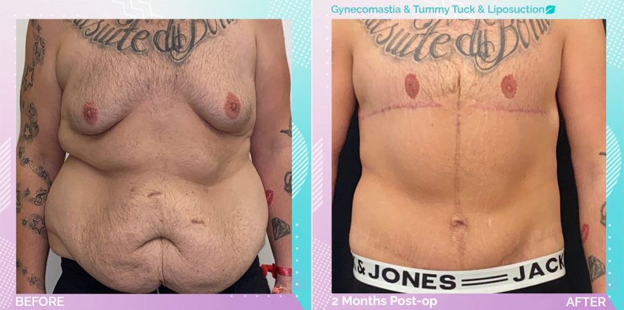 Gynecomastia and Liposuction and Tummy Tuck before and after, Body