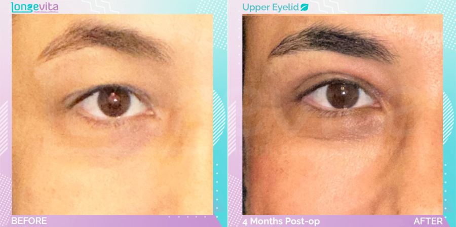 Eyelid before and after, Face
