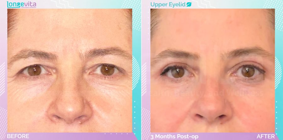 Eyelid before and after, Face
