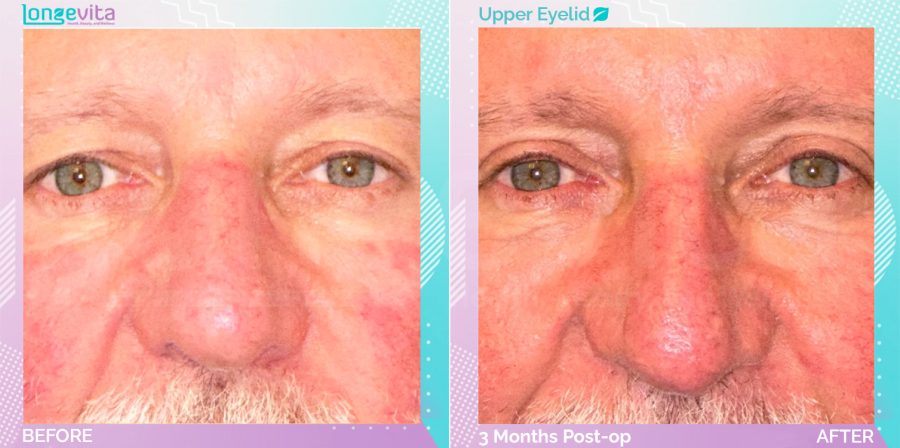 Eyelid before and after, Face
