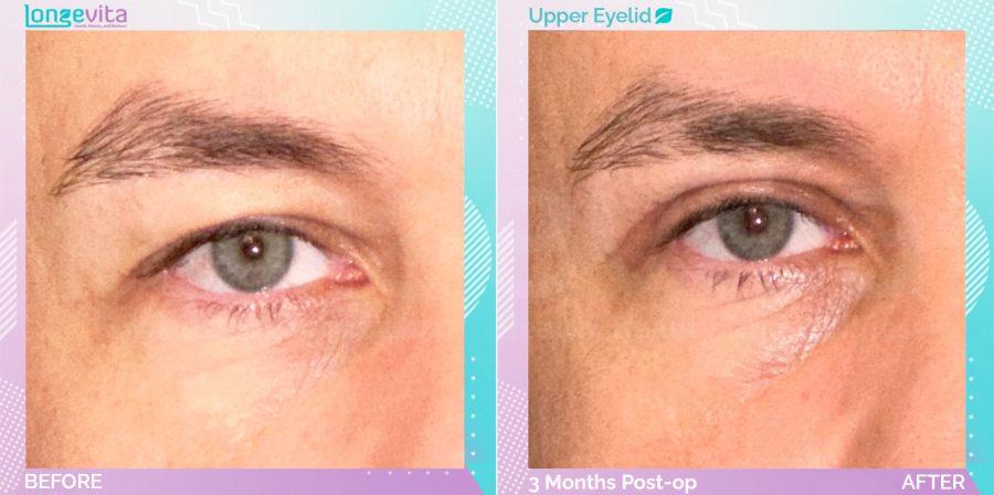 Eyelid before and after, Face