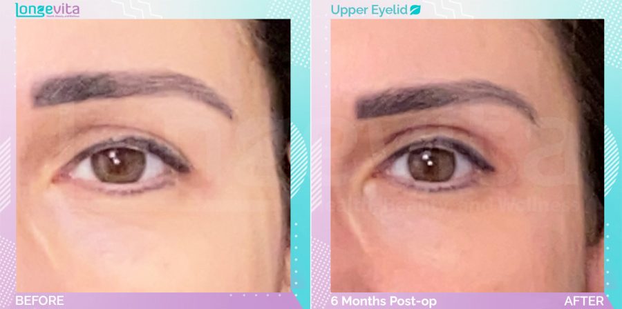 Eyelid before and after, Face