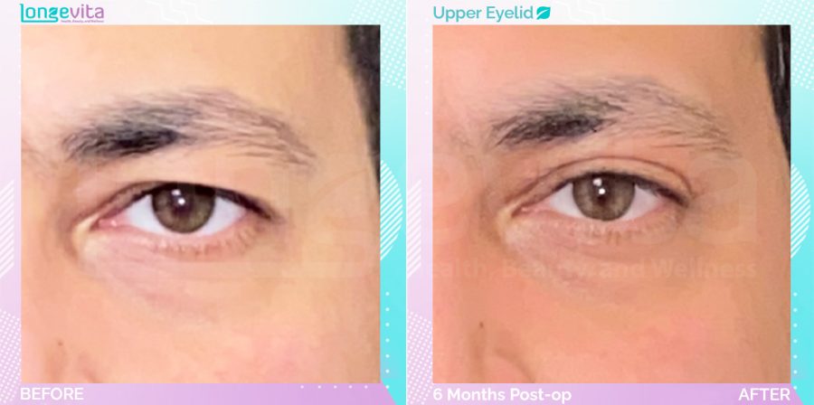 Eyelid before and after, Face