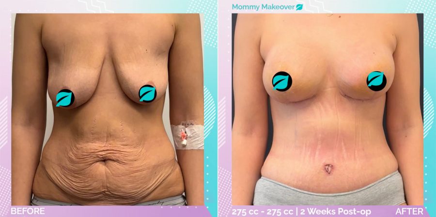 Breast Enlargement and Breast Lift and Liposuction and Tummy Tuck before and after, Body