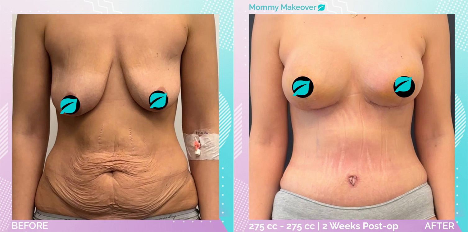 Breast Enlargement and Breast Lift and Liposuction and Tummy Tuck before and after, Body