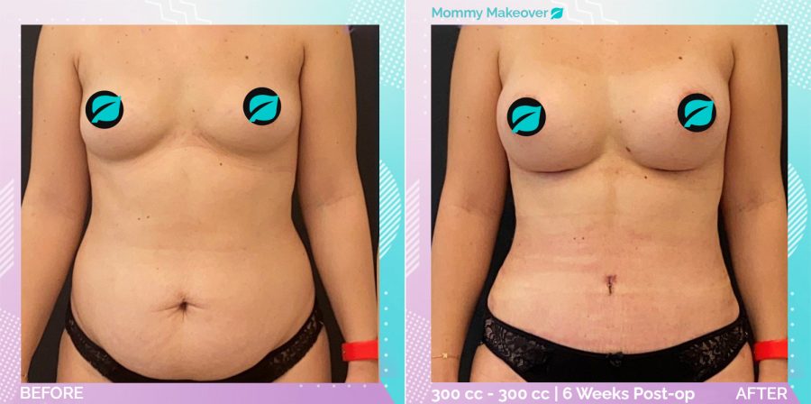 Breast Enlargement and Liposuction and Tummy Tuck before and after, Body