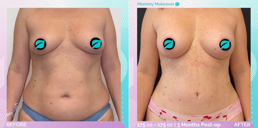 Breast Enlargement and Liposuction and Tummy Tuck before and after, Body