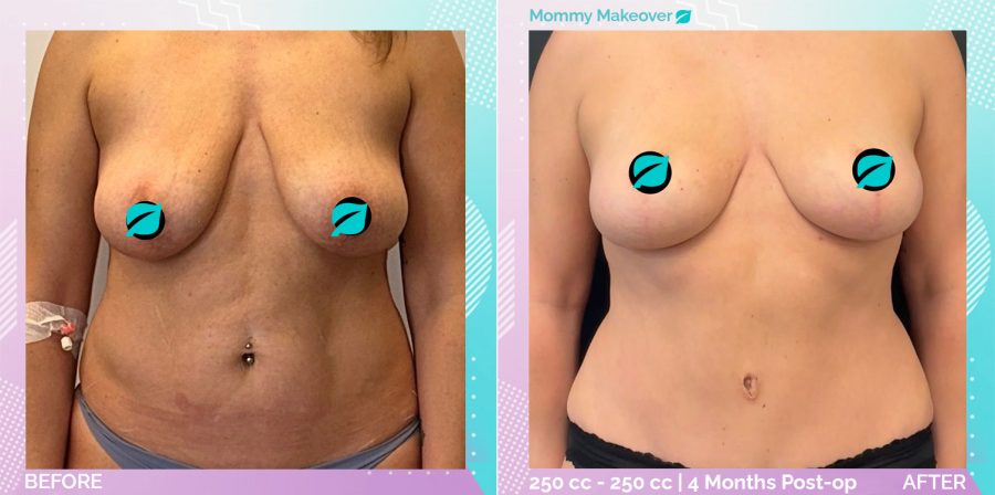 Breast Enlargement and Breast Lift and Liposuction and Tummy Tuck before and after, Body
