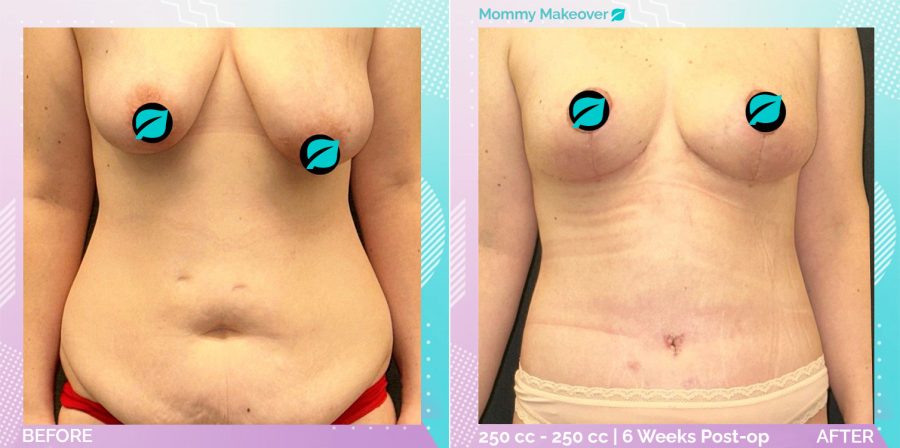 Breast Enlargement and Breast Lift and Liposuction and Tummy Tuck before and after, Body
