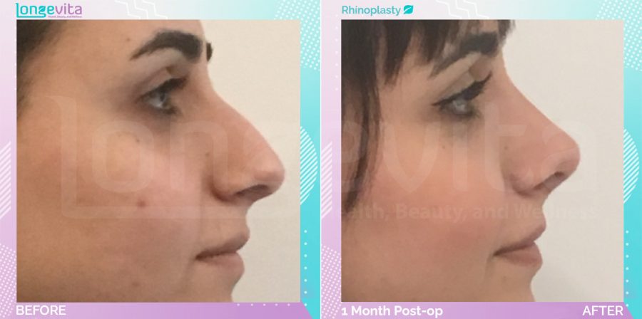 Rhinoplasty before and after, Face
