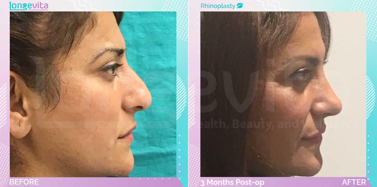 Rhinoplasty before and after, Face