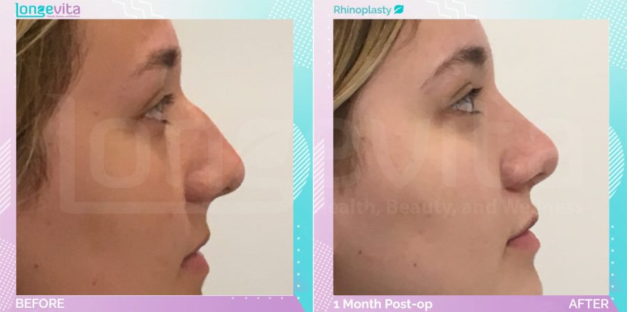 Rhinoplasty before and after, Face