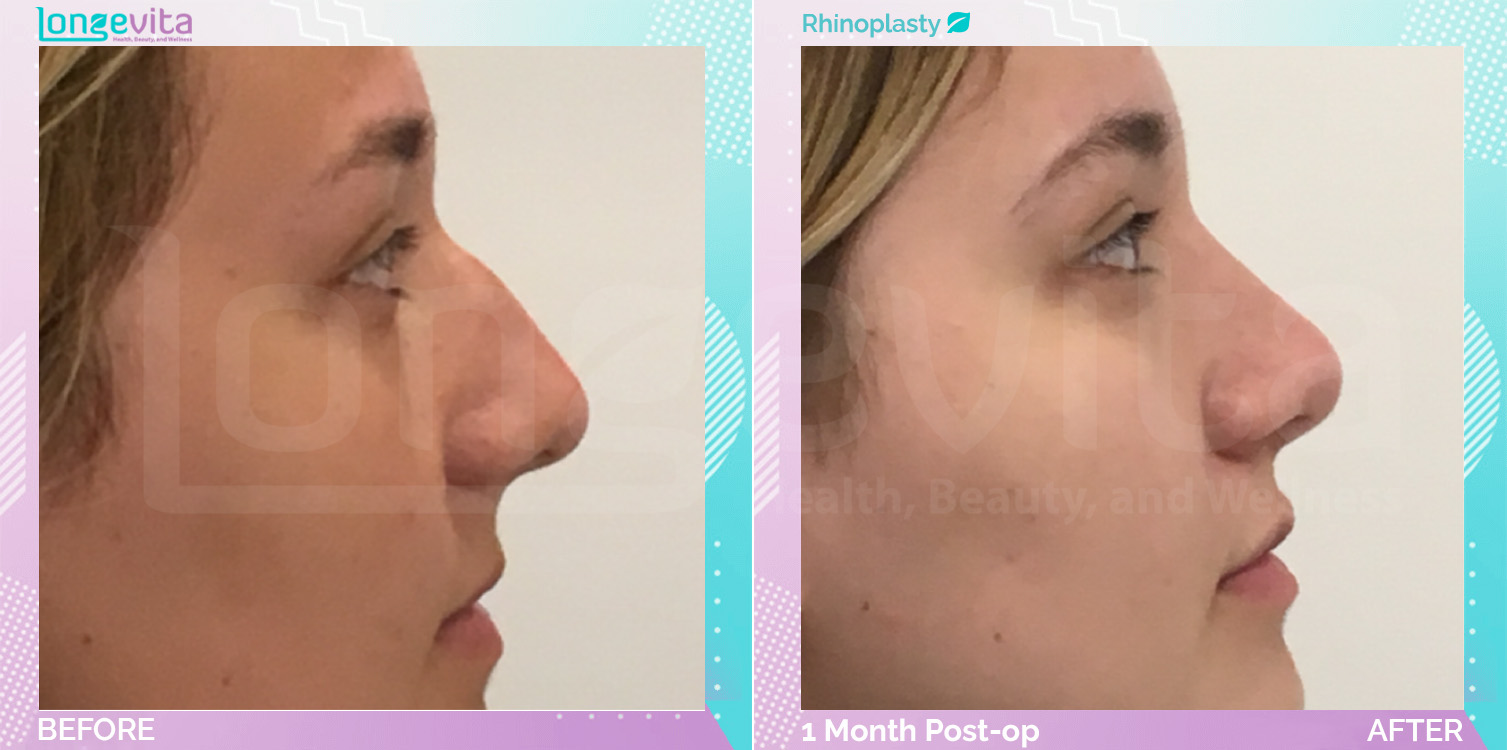 Rhinoplasty before and after, Face
