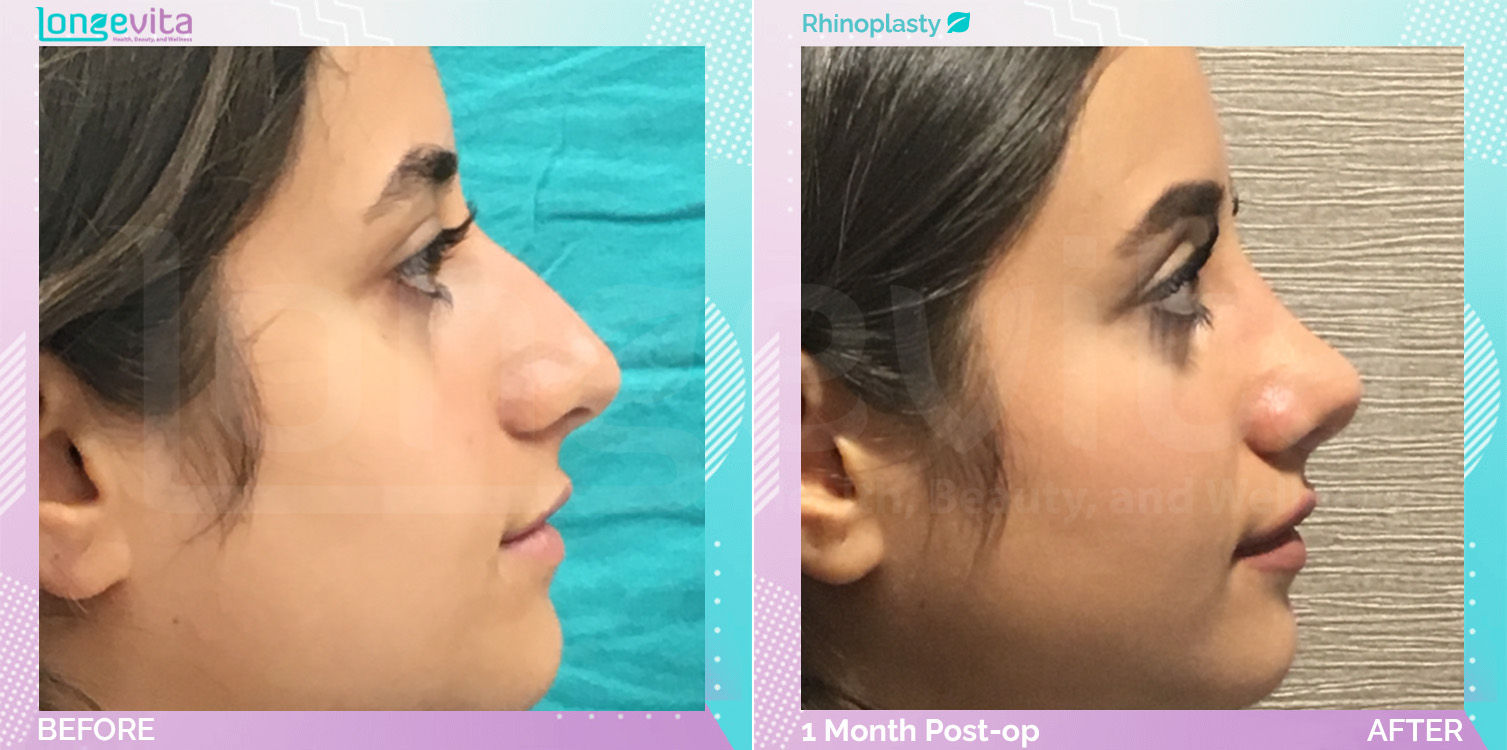 Rhinoplasty before and after, Face