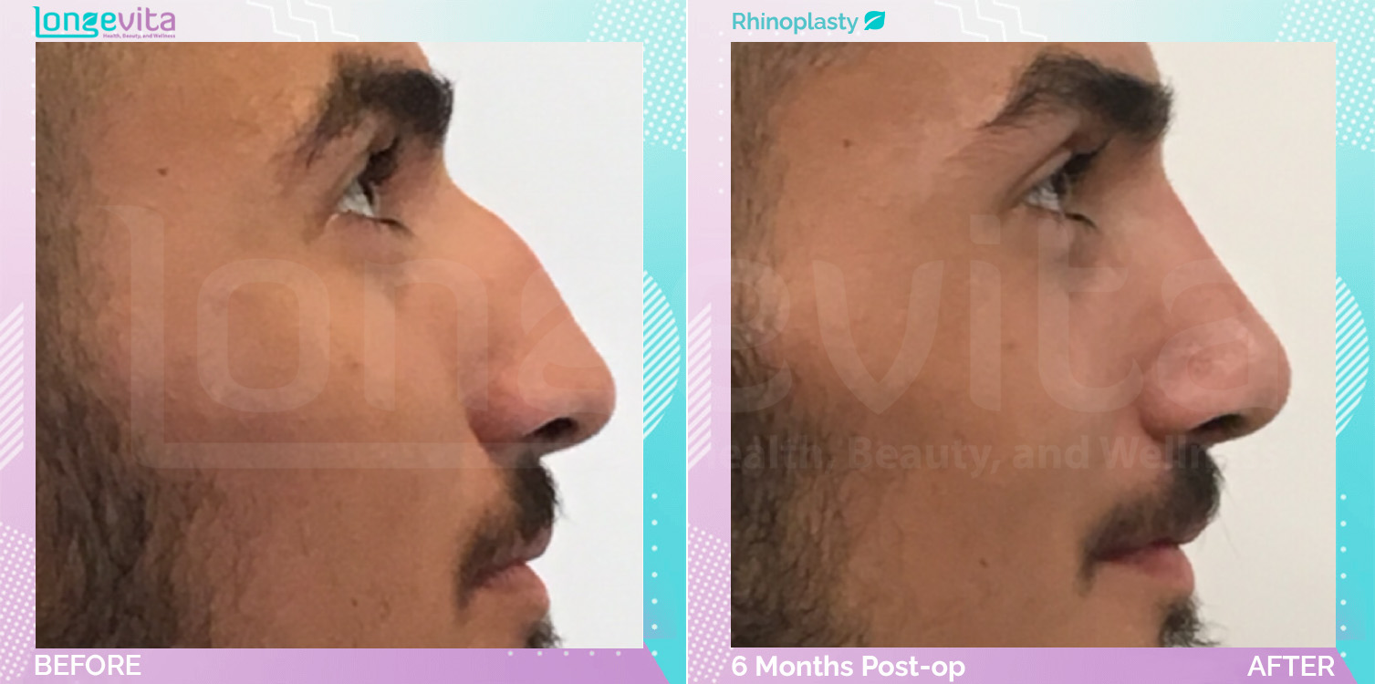 Rhinoplasty before and after, Face