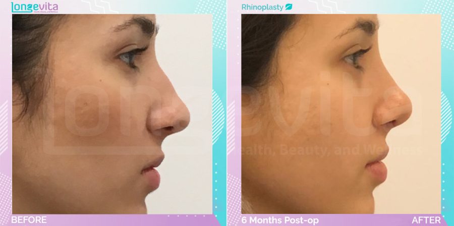 Rhinoplasty before and after, Face