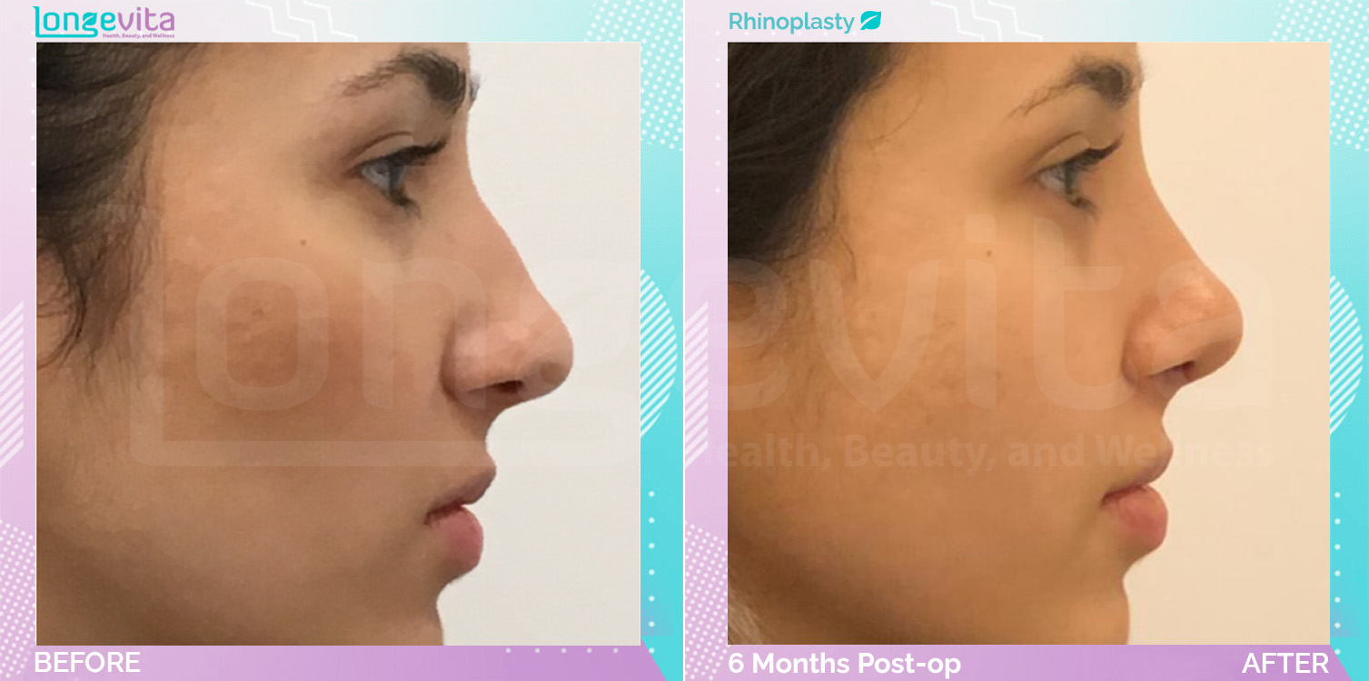 Rhinoplasty before and after, Face