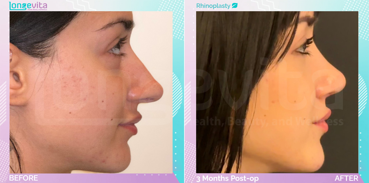 Rhinoplasty before and after, Face