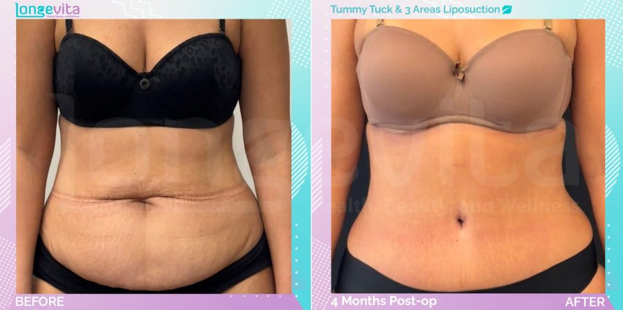 Liposuction and Tummy Tuck before and after, Body