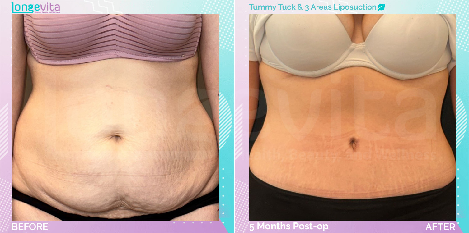 Liposuction and Tummy Tuck before and after, Body