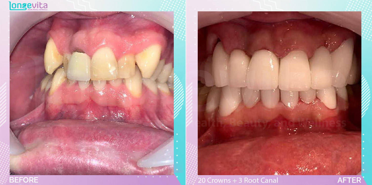 Crowns and Extraction and Hollywood Smile and Root Canal before and after, 20 Porcelain Crowns + 3 Root Canal + Extraction units, 30s male patient