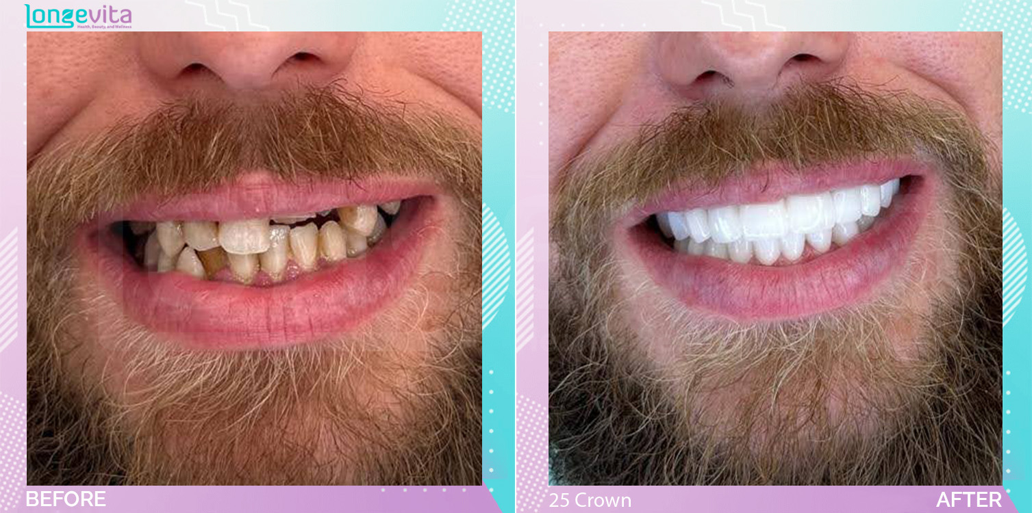 Crowns and Extraction and Hollywood Smile and Root Canal before and after, 25 Porcelain Crowns + 4 Extraction  + Root Canal units, 30s male patient