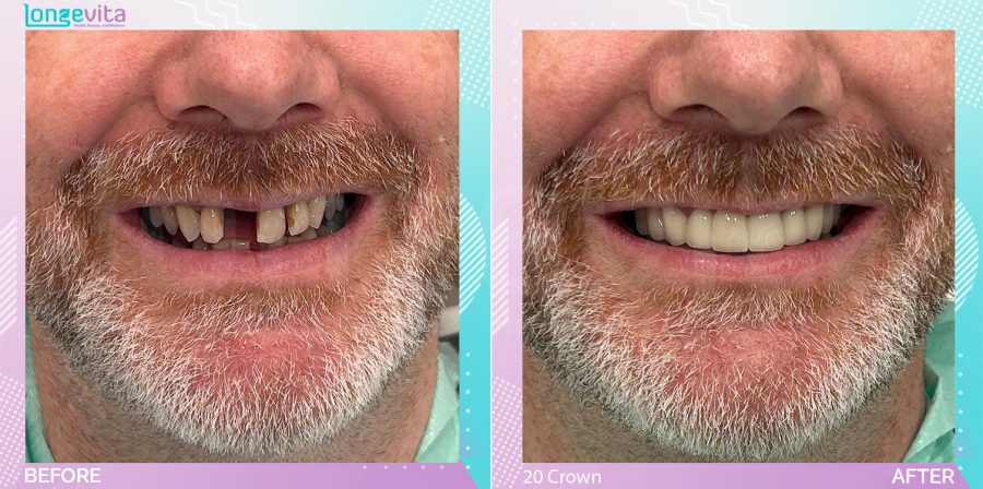 Crowns and Extraction and Hollywood Smile before and after, 20 Porcelain Crown + Extraction units, 50s male patient