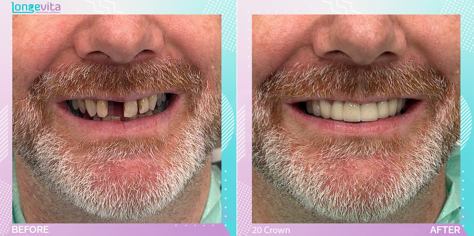 Crowns and Extraction and Hollywood Smile before and after, 20 Porcelain Crown + Extraction units, 50s male patient