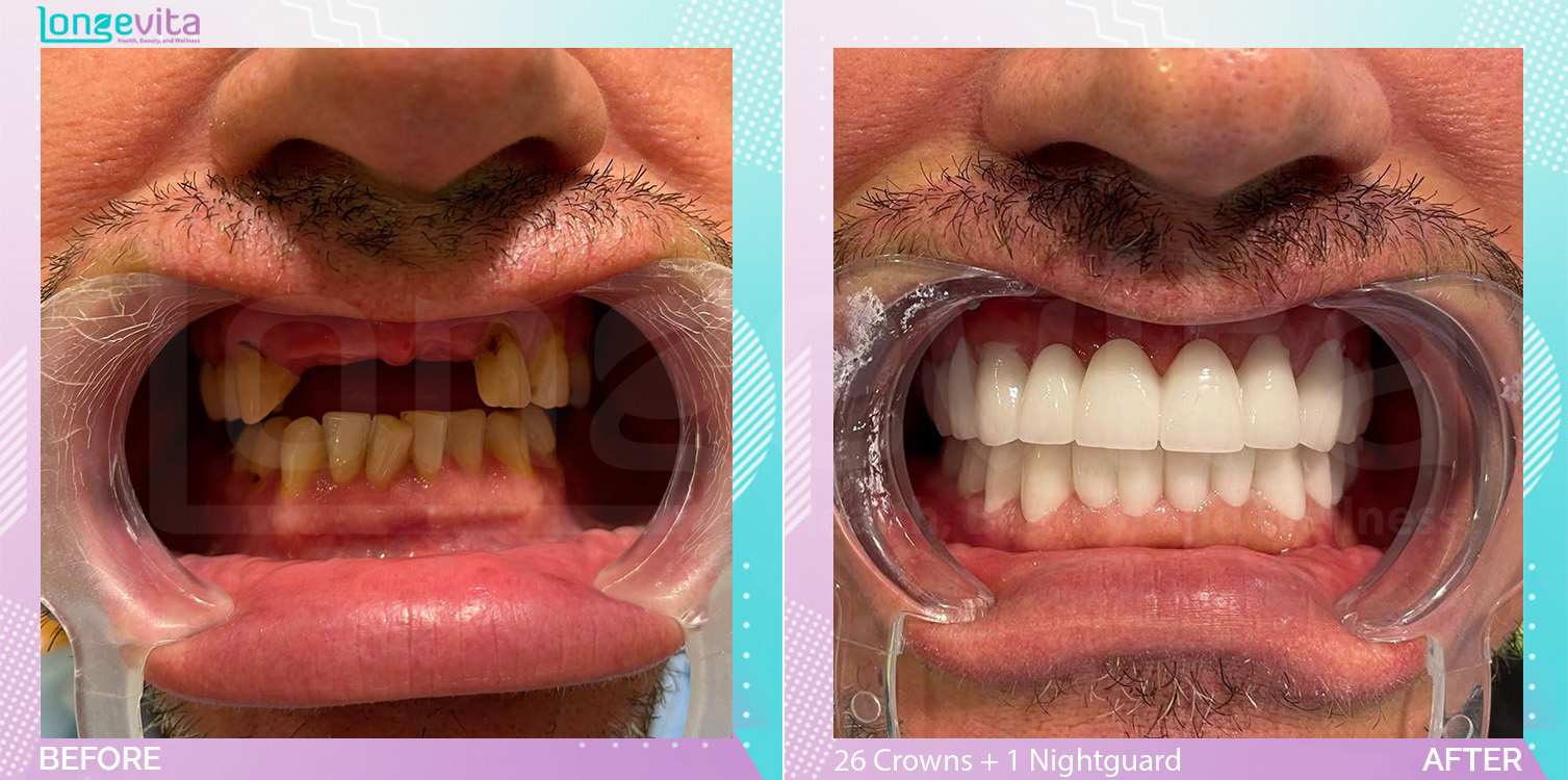 Crowns and Extraction and Nightguard before and after, 26 Porcelain Crowns + 1 Nightguard + 2 extraction units