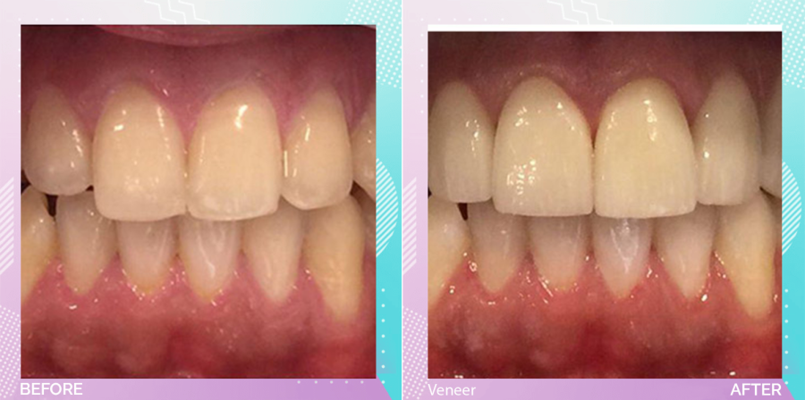 Veneers before and after, N/A units