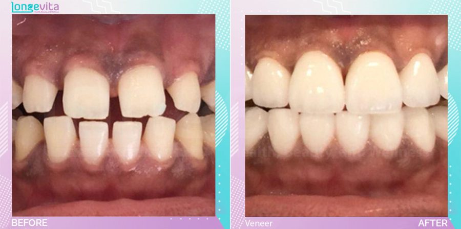 Veneers before and after, N/A units