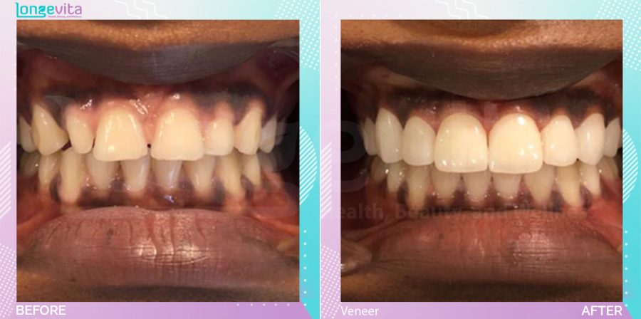 Veneers before and after, N/A units