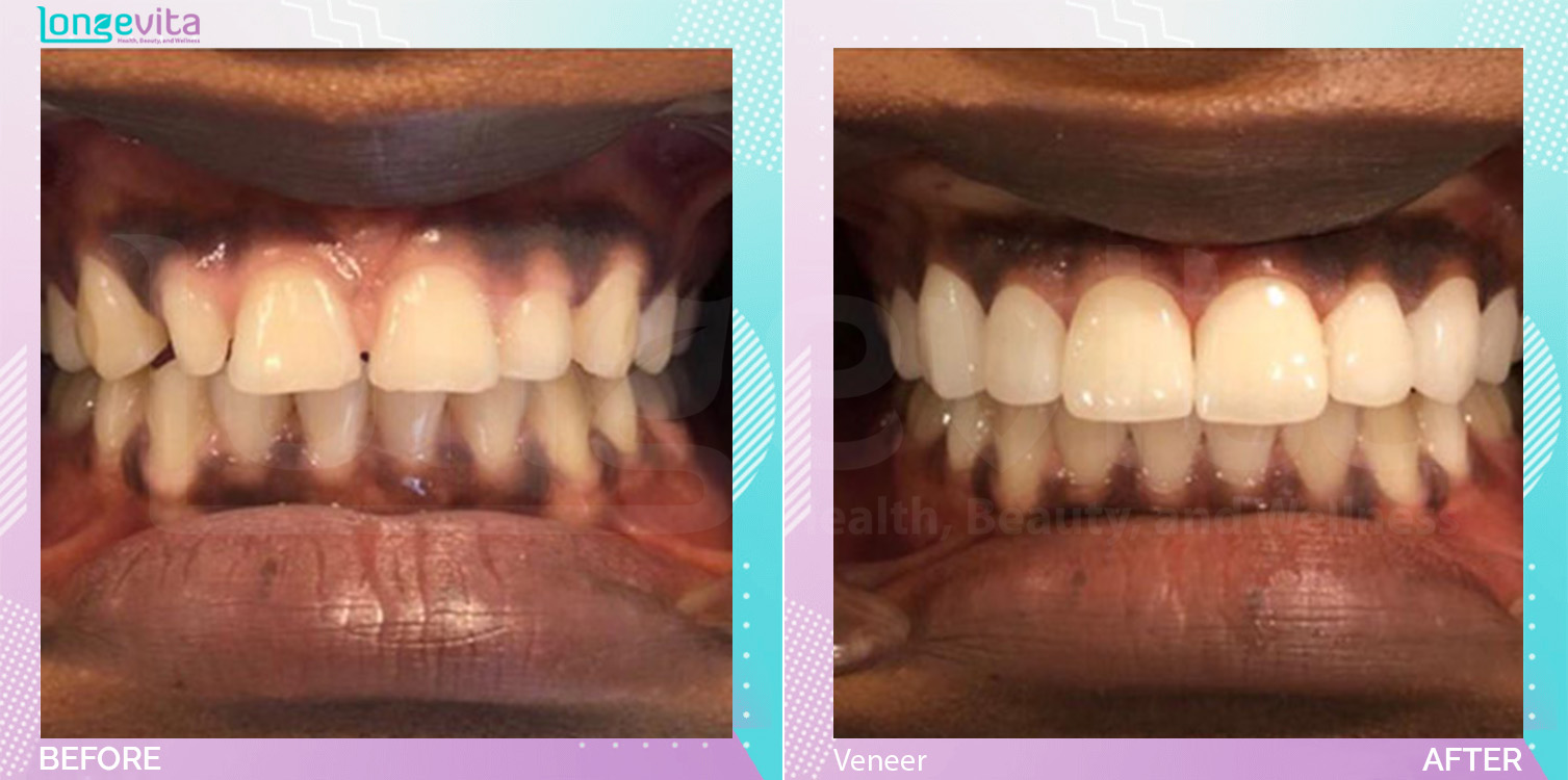 Veneers before and after, N/A units