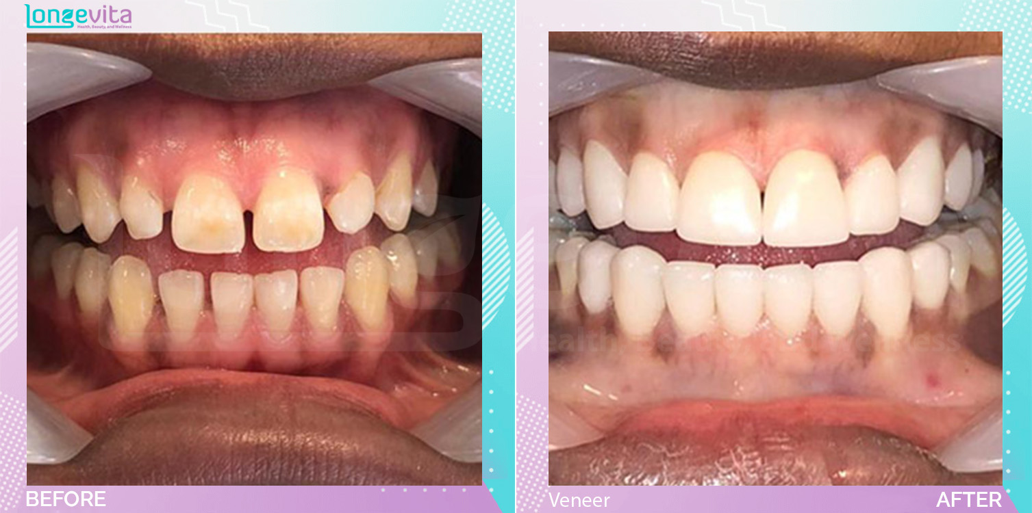 Veneers before and after, N/A units