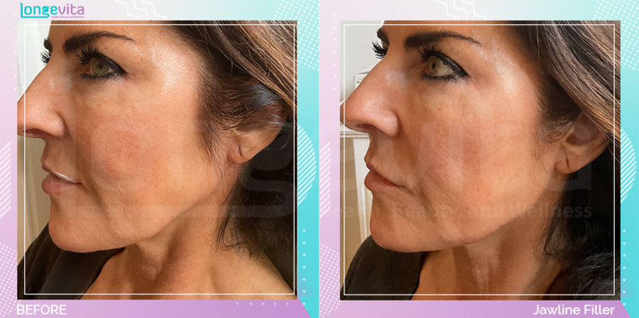 Dermal Fillers before and after, Face