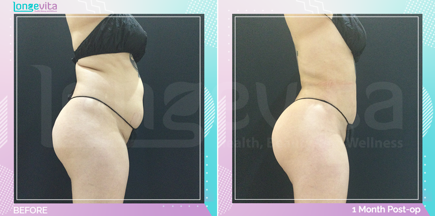 Bum Lift and Liposuction before and after, Body
