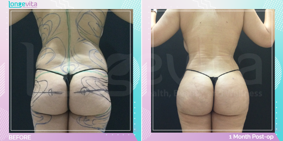 Bum Lift and Liposuction before and after, Body