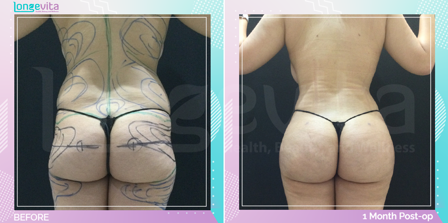 Bum Lift and Liposuction before and after, Body