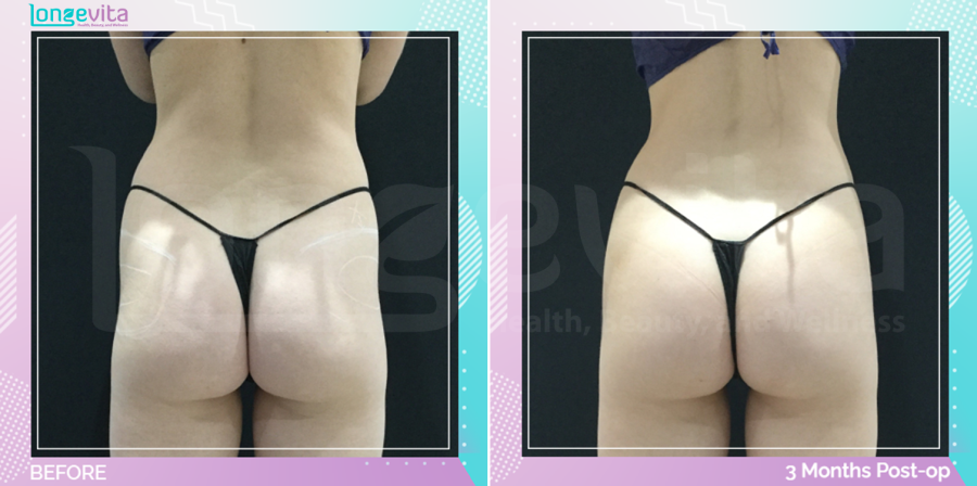 Bum Lift and Liposuction before and after, Body