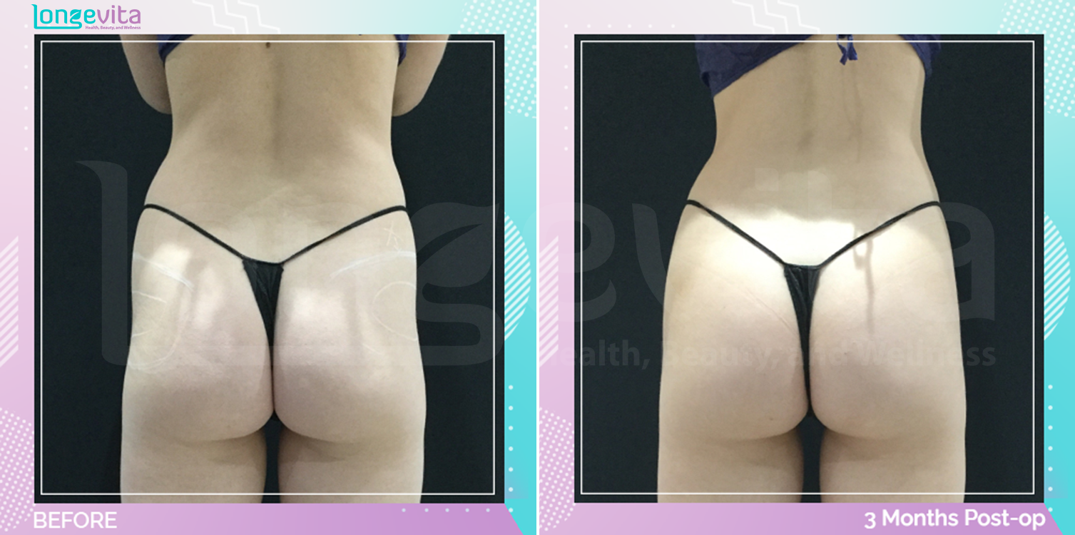 Bum Lift and Liposuction before and after, Body