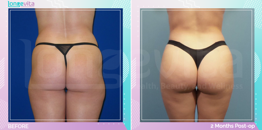 Bum Lift and Liposuction before and after, Body